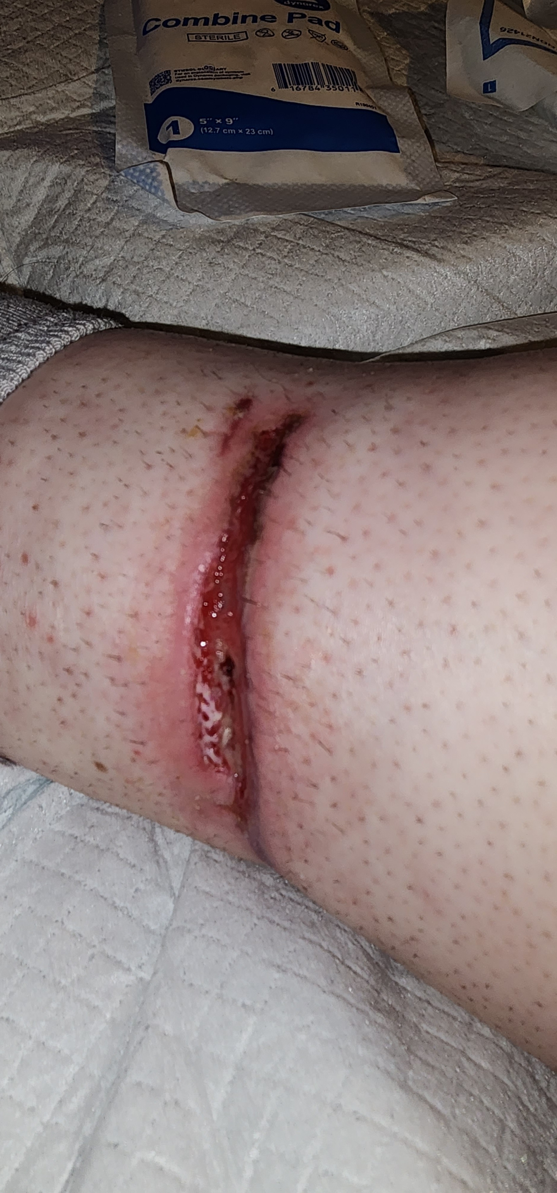 Dog bite wound