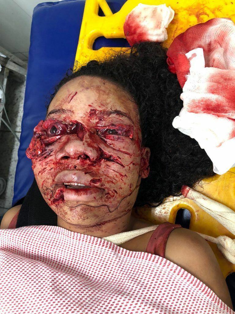 Pitbull Rips Owner's Face off