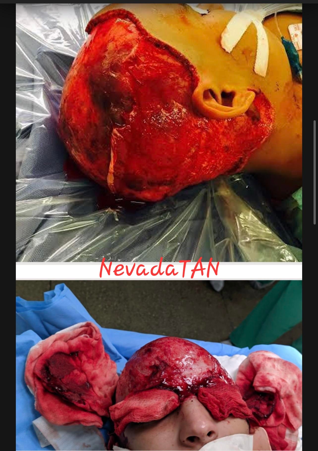 Kids scalp pulled off in a Go-Kart accident