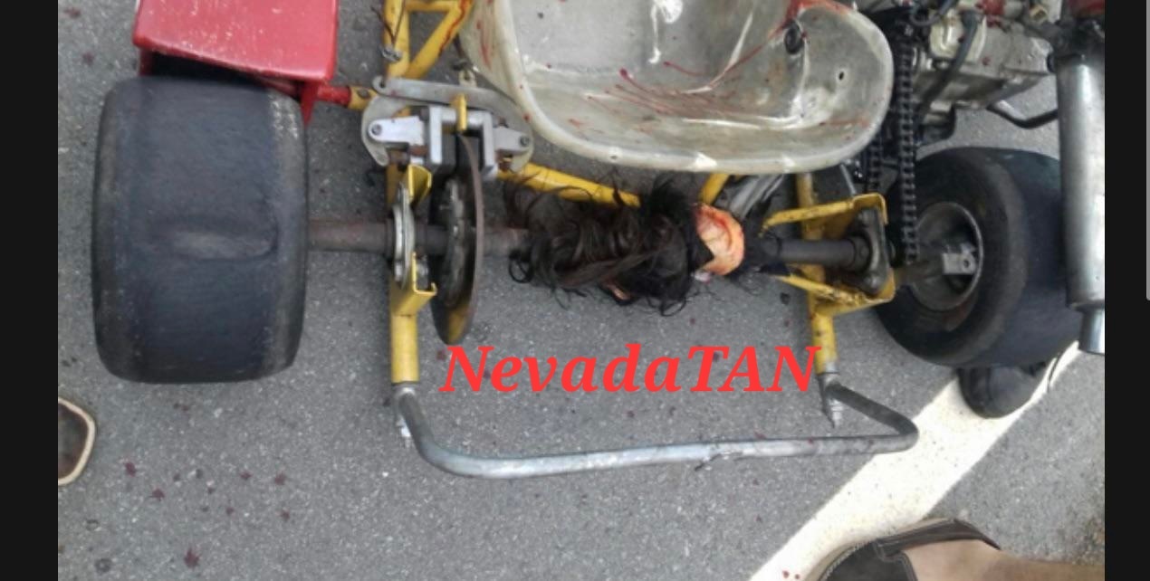 Kids scalp pulled off in a Go-Kart accident