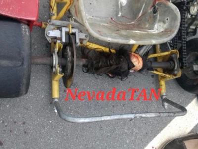 Kids scalp pulled off in a Go-Kart accident