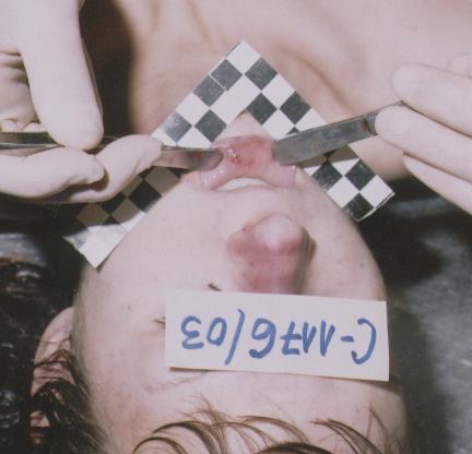 Woman Facial Dissection