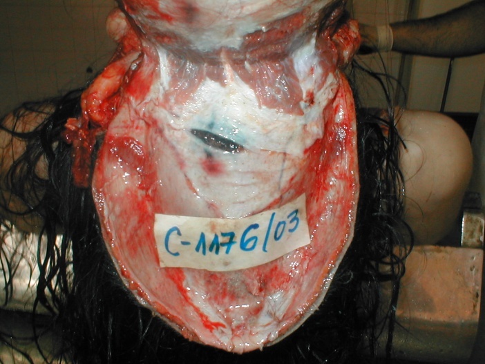 Woman Facial Dissection