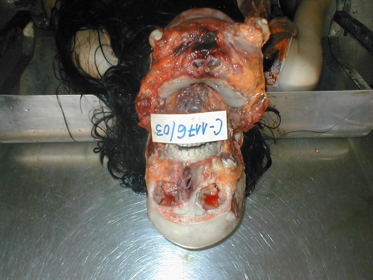 Woman Facial Dissection