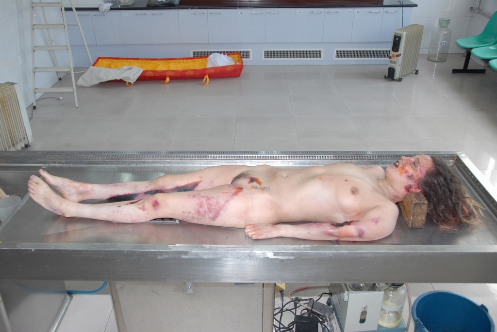 Bald Woman Autopsy