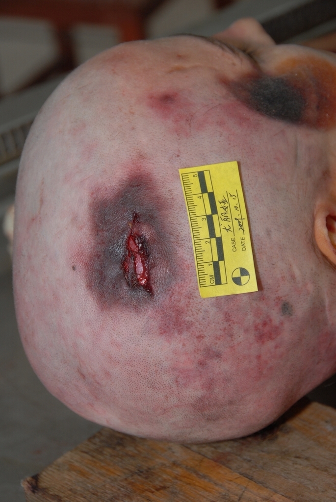 Bald Woman Autopsy