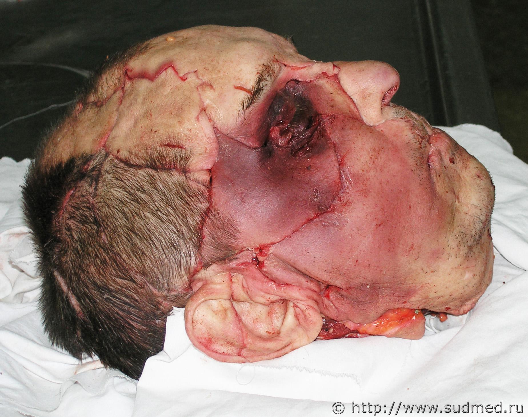 Russian Alcoholic Dismembers Another Alcoholics Head