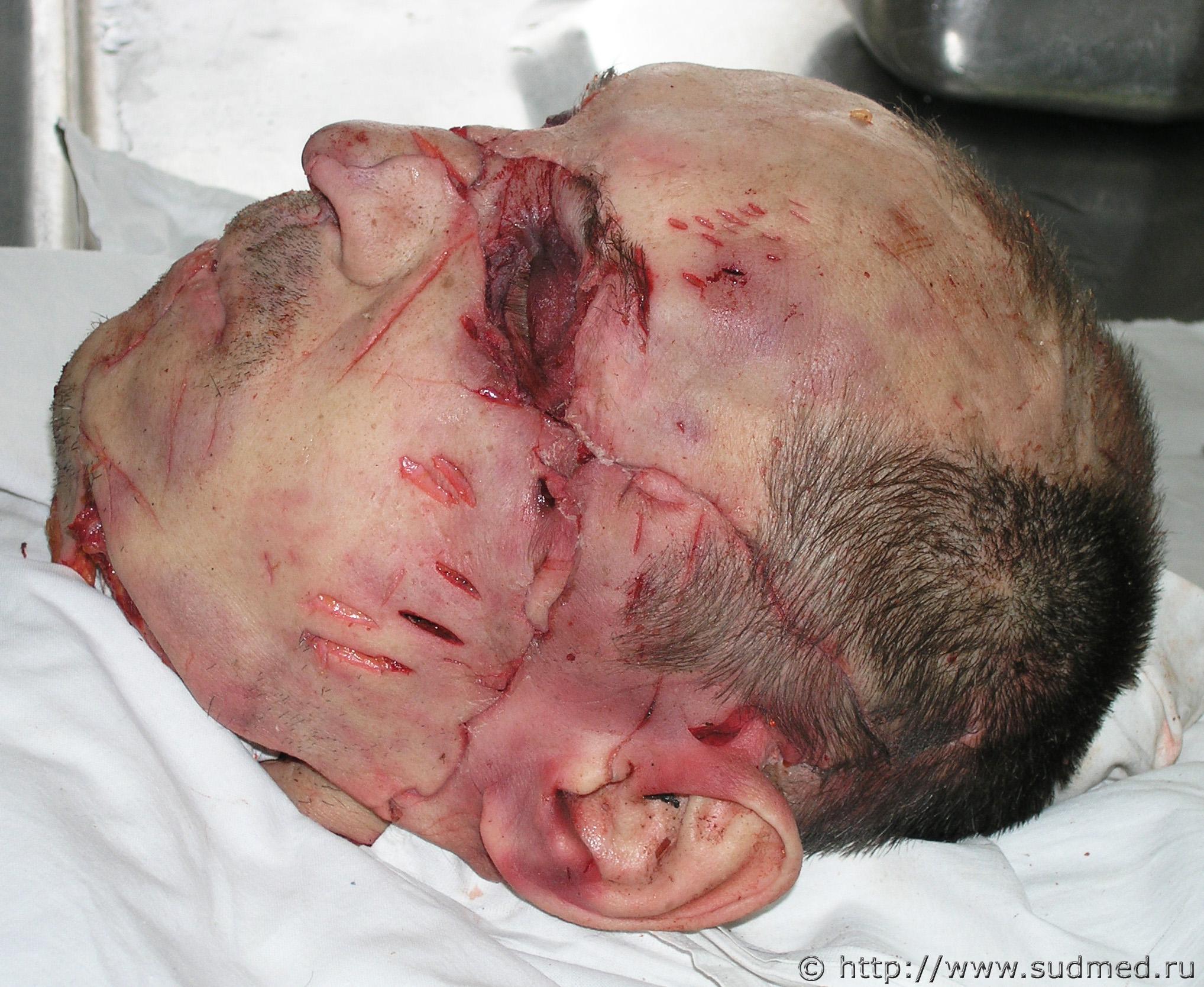 Russian Alcoholic Dismembers Another Alcoholics Head