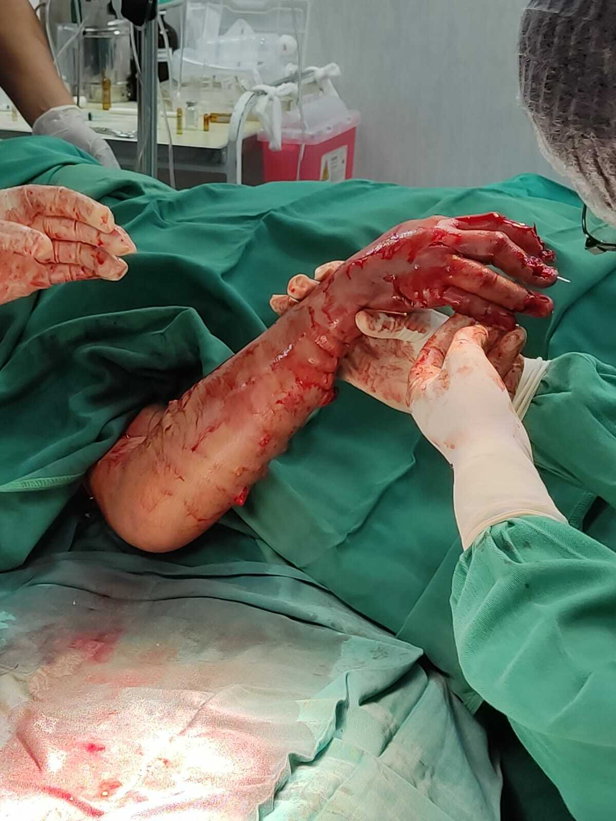 Arm reconstruction of the police officer in Lima bus accident.