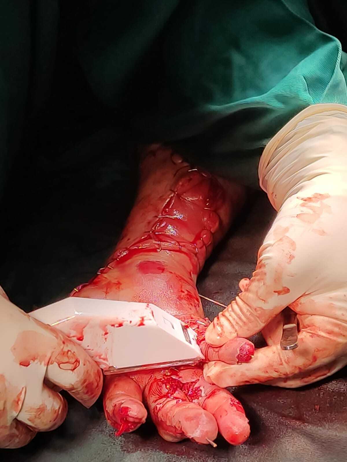 Arm reconstruction of the police officer in Lima bus accident.