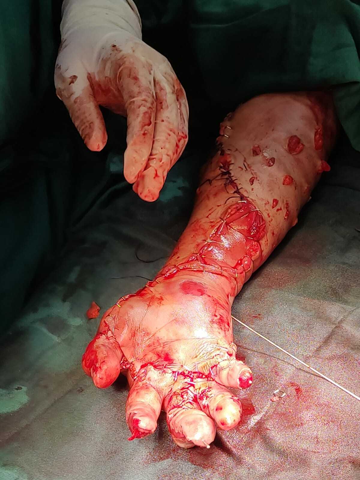 Arm reconstruction of the police officer in Lima bus accident.