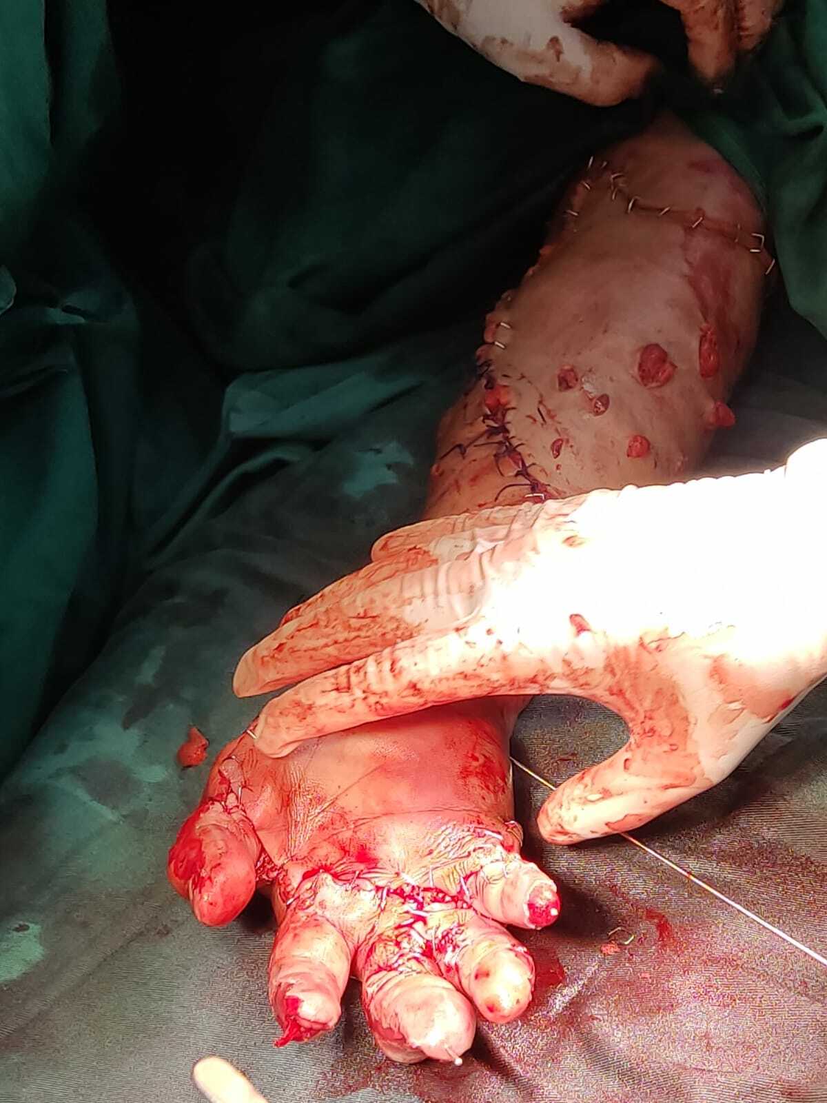 Arm reconstruction of the police officer in Lima bus accident.