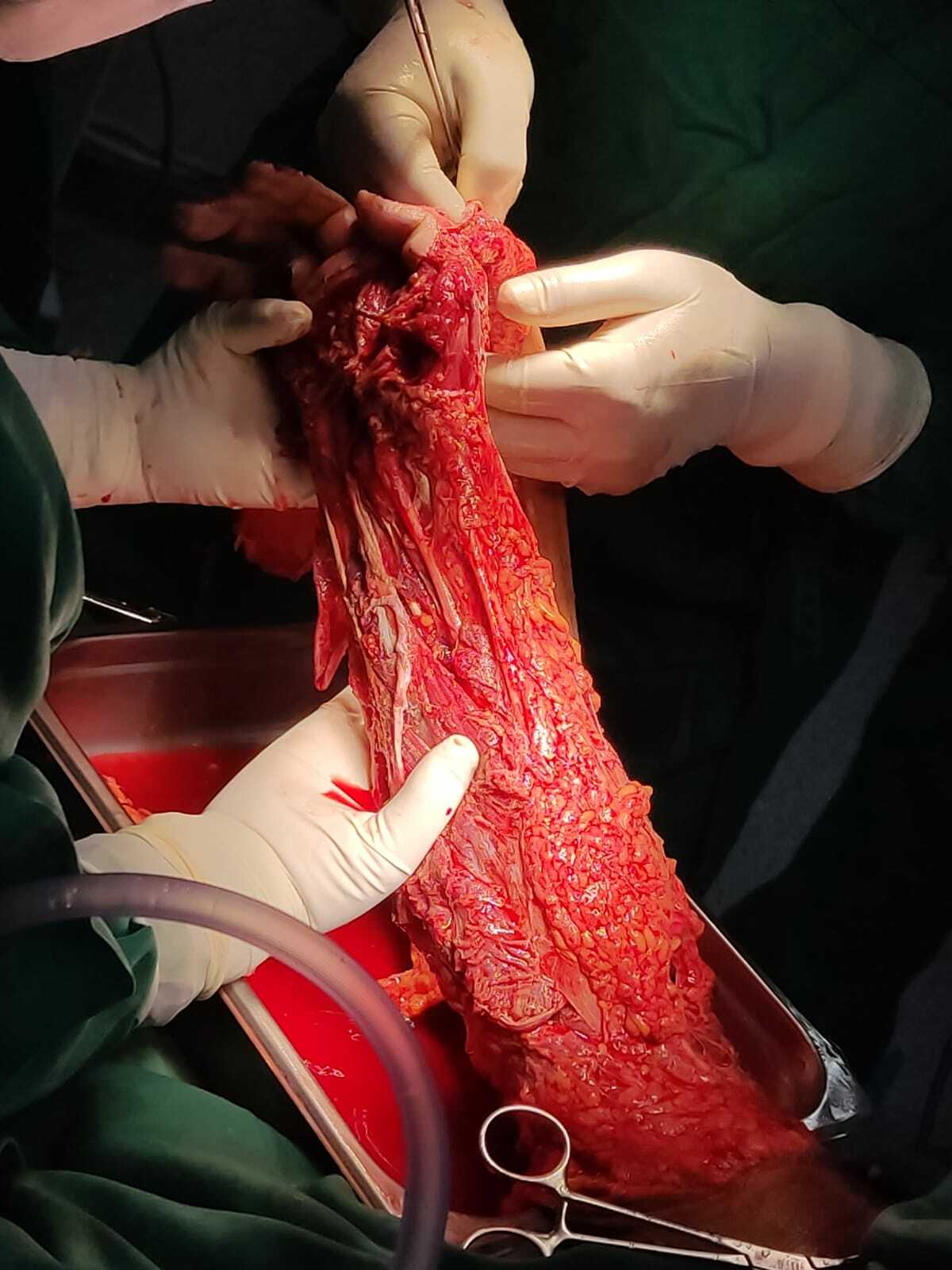 Arm reconstruction of the police officer in Lima bus accident.