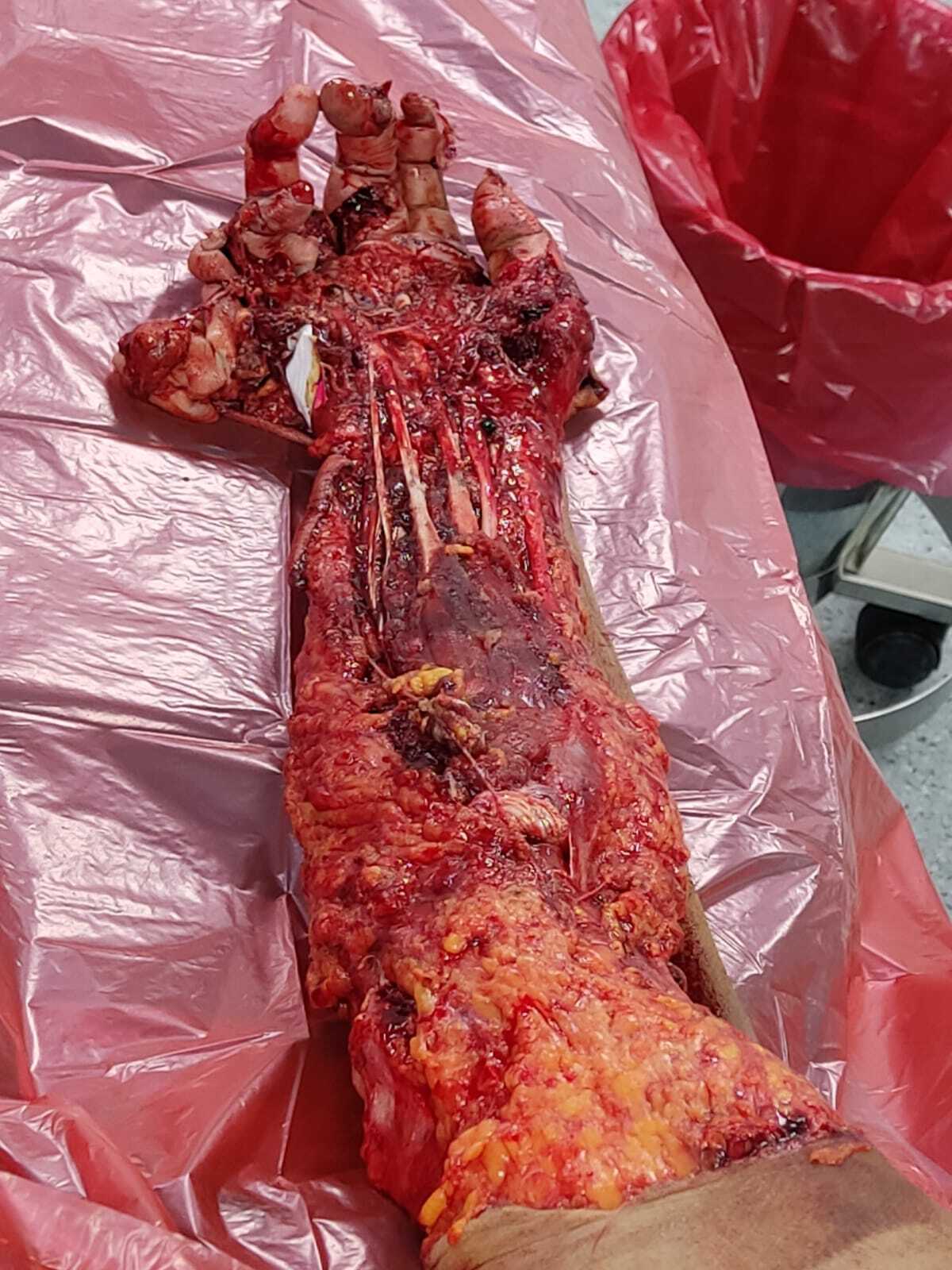 Arm reconstruction of the police officer in Lima bus accident.