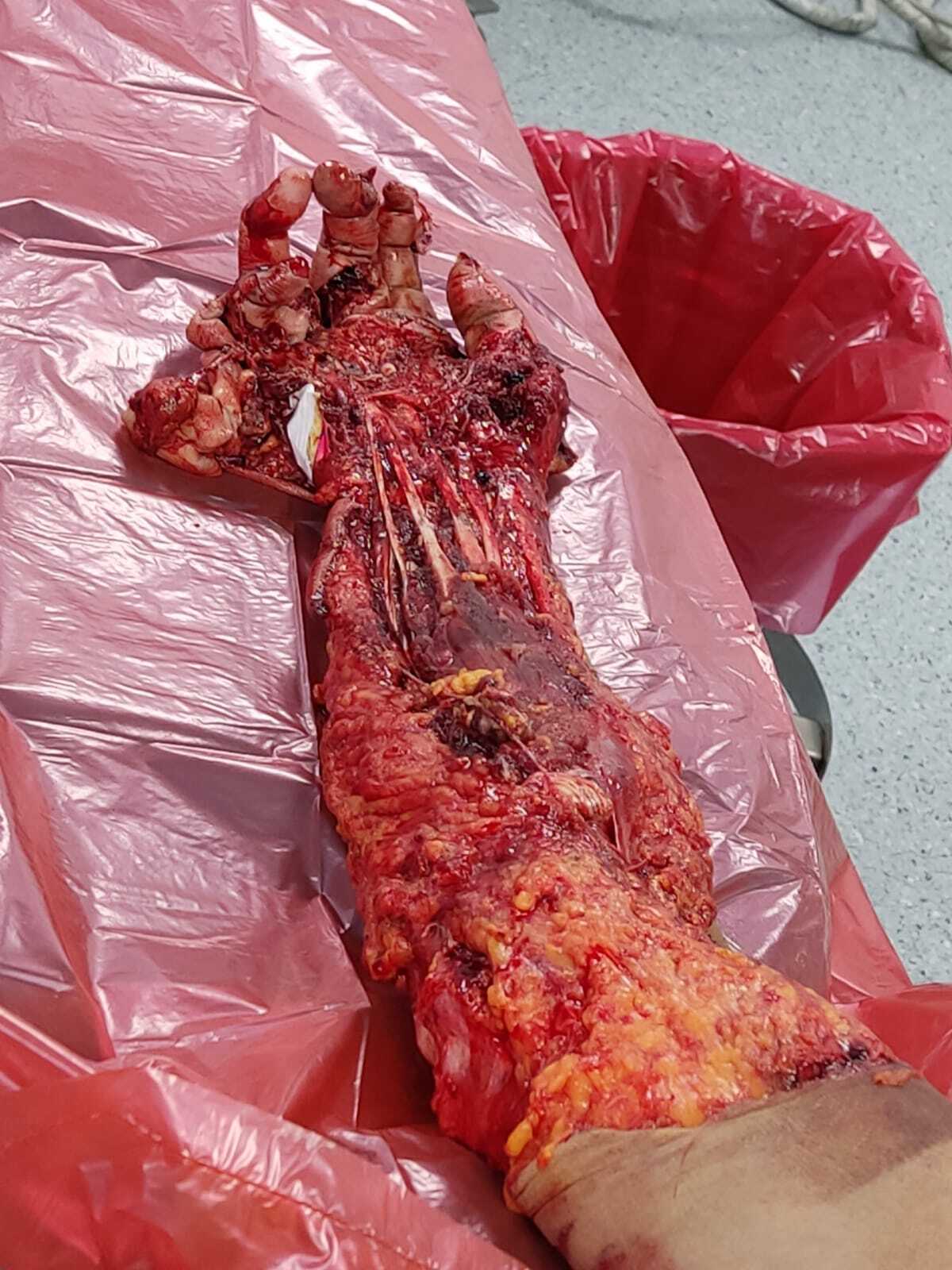 Arm reconstruction of the police officer in Lima bus accident.