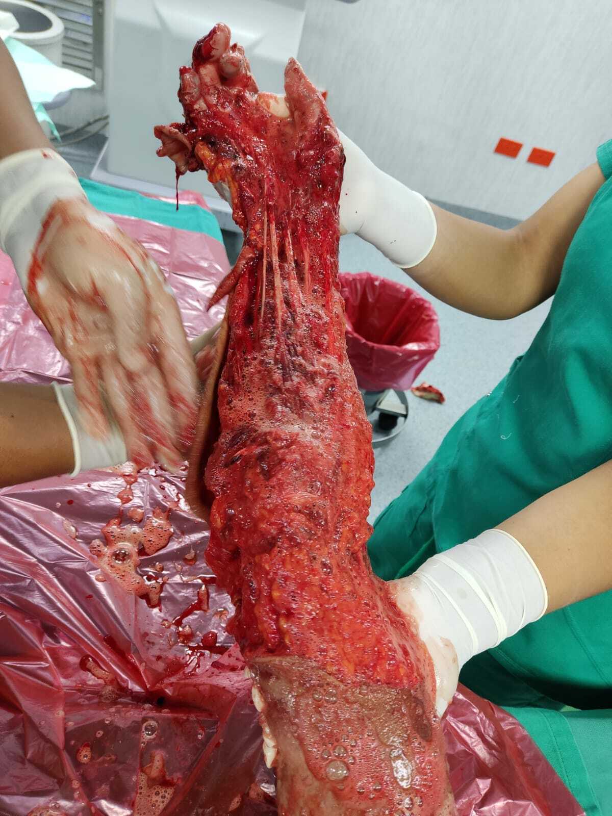 Arm reconstruction of the police officer in Lima bus accident.