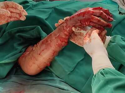 Arm reconstruction of the police officer in Lima bus accident.