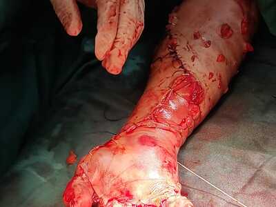 Arm reconstruction of the police officer in Lima bus accident.