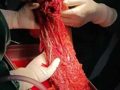 Arm reconstruction of the police officer in Lima bus accident.