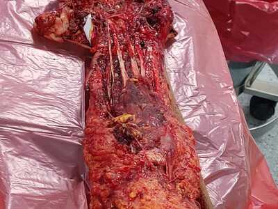 Arm reconstruction of the police officer in Lima bus accident.