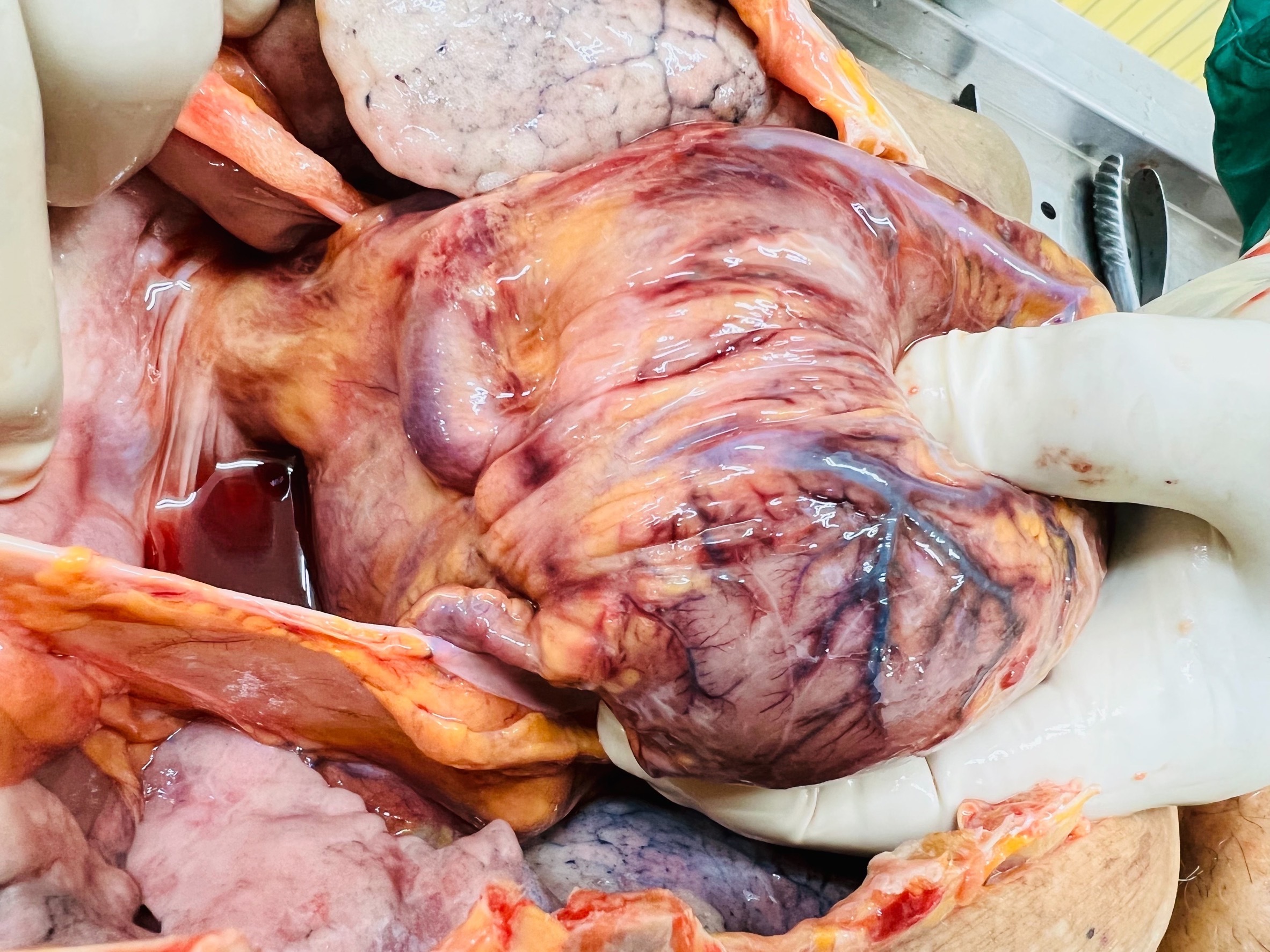 Autopsy, necrotic tissue