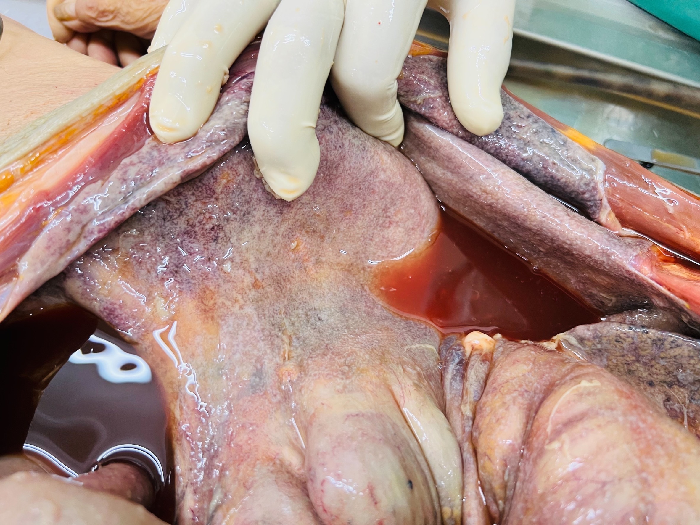 Autopsy, necrotic tissue