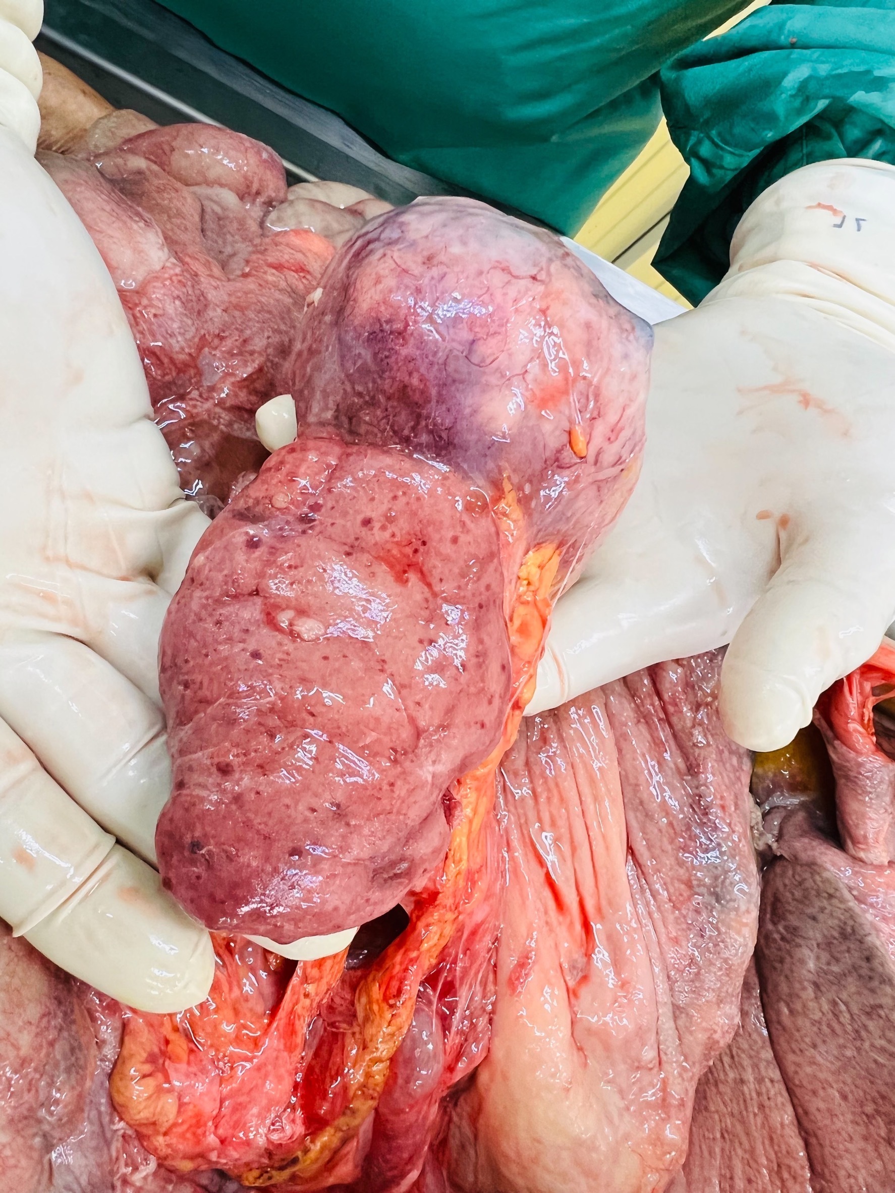 Autopsy, necrotic tissue