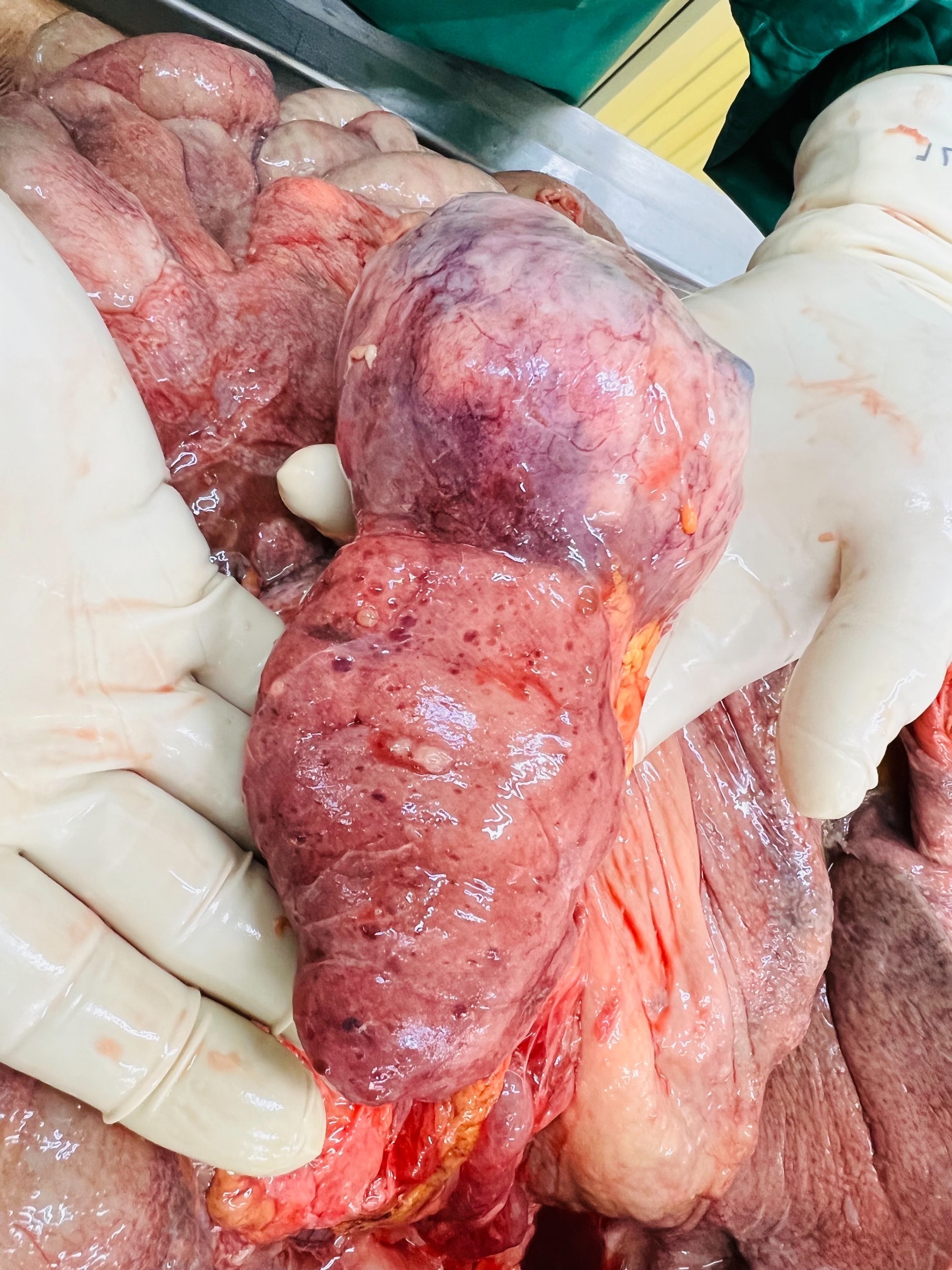 Autopsy, necrotic tissue