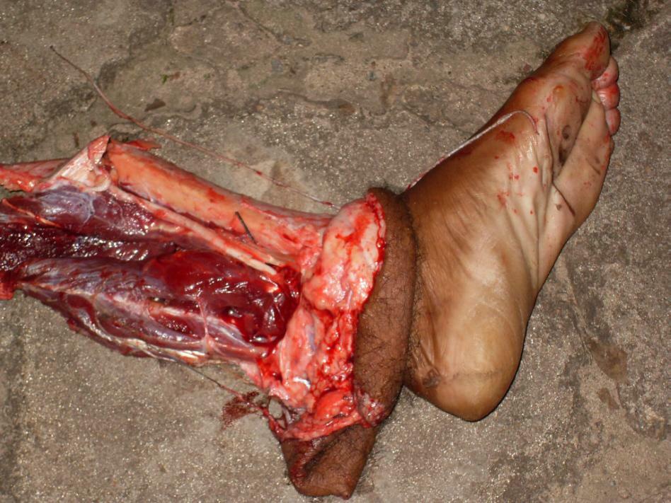 Severed Foot of a Man