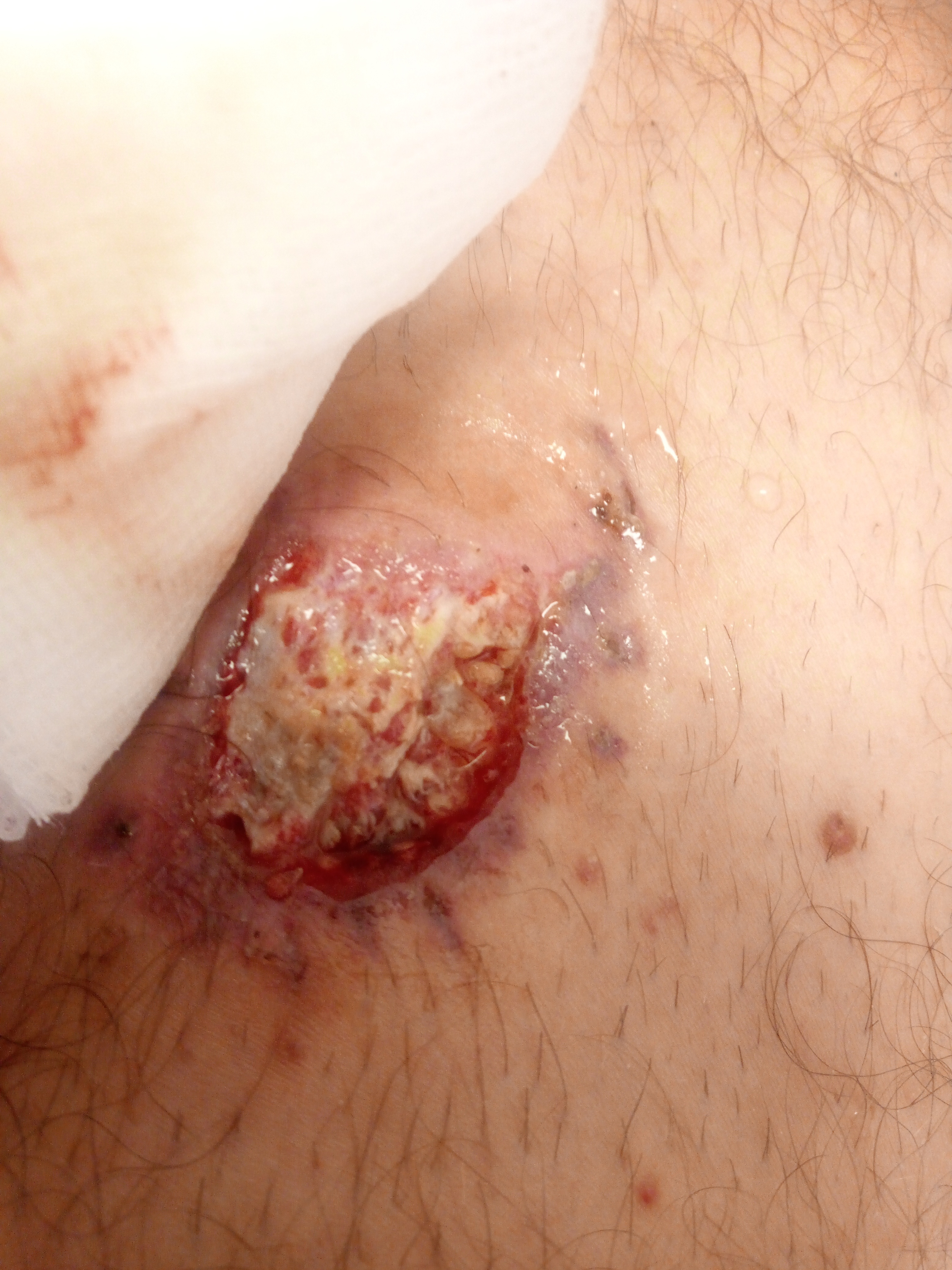 Bike crash injuries.