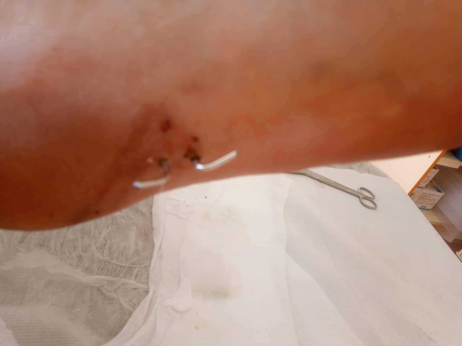 Bike crash injuries.