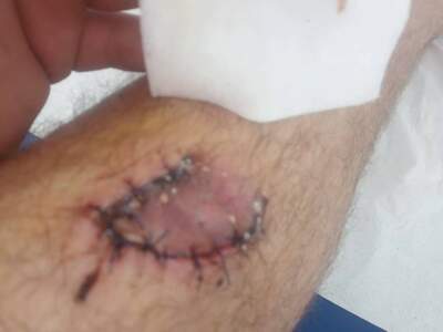 Bike crash injuries.