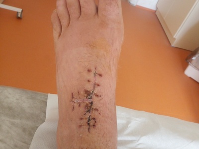 Bike crash injuries.