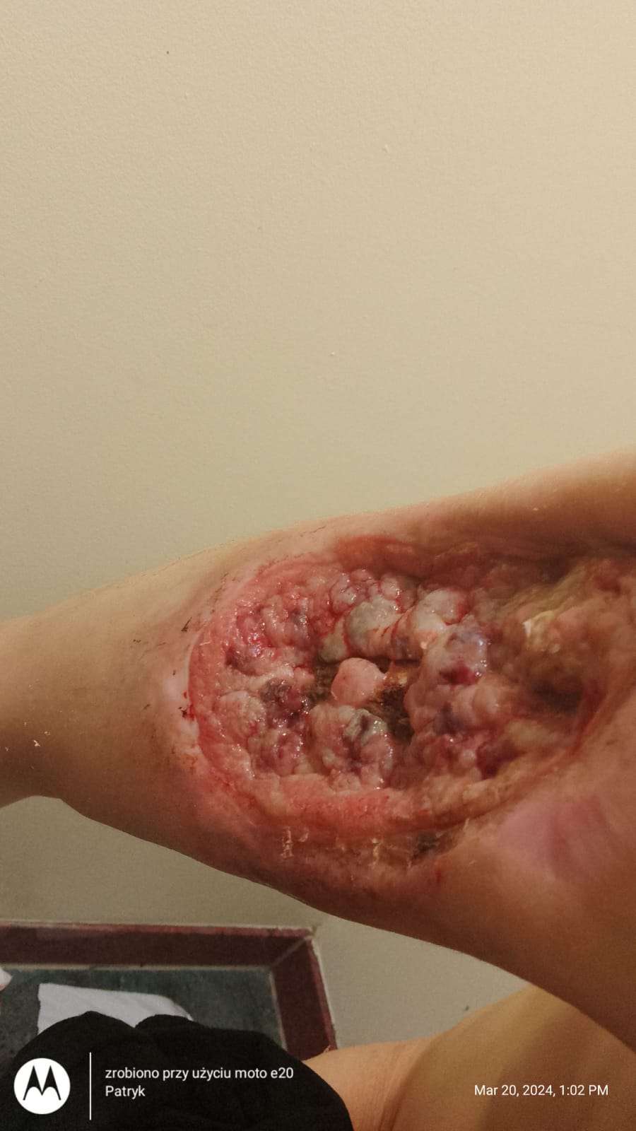 Necrosis in heroin user.