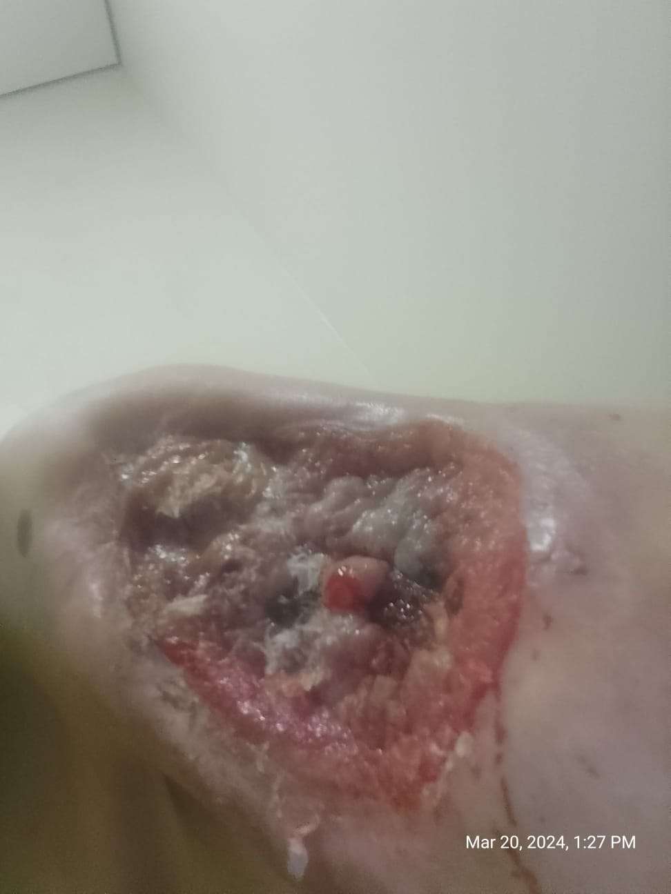 Necrosis in heroin user.