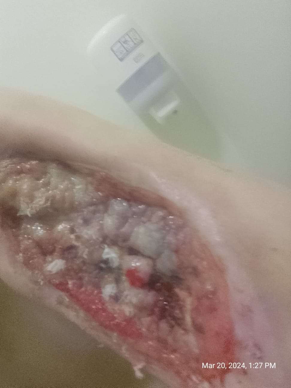 Necrosis in heroin user.
