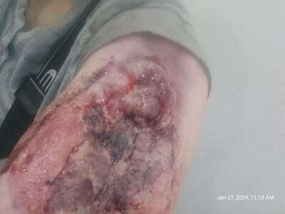 Necrosis in heroin user.