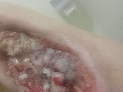 Necrosis in heroin user.