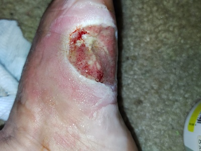 Burned foot aftermath, after 2 surgeries