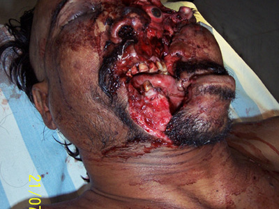 Extensive cranio facial