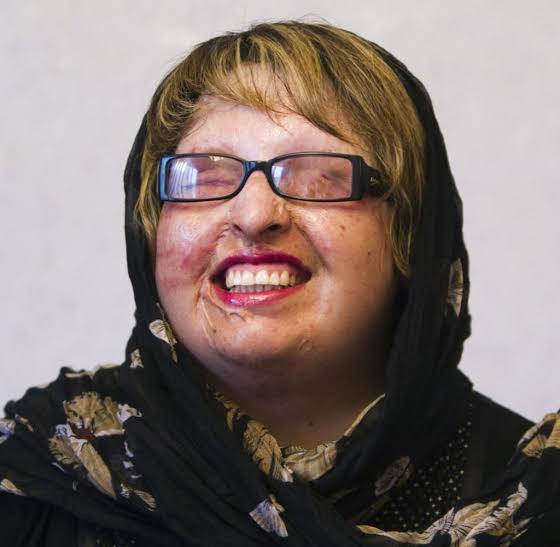 Student Pours Acid On Iranian Woman Because Of Rejected Love