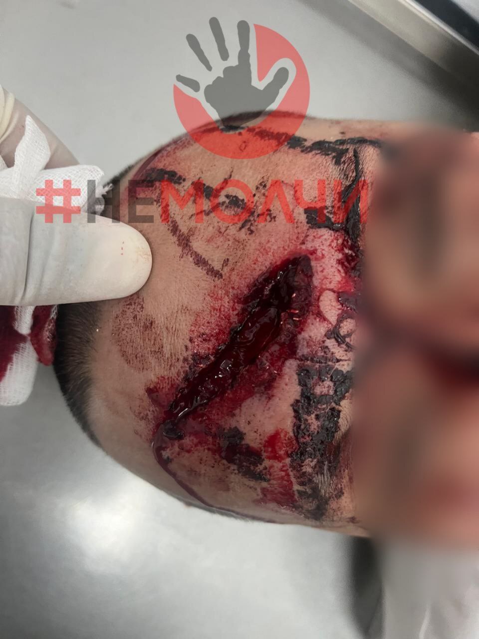 Ex-Husband Attacks Wife And Her Boyfriend With Bat In Kazakhstan