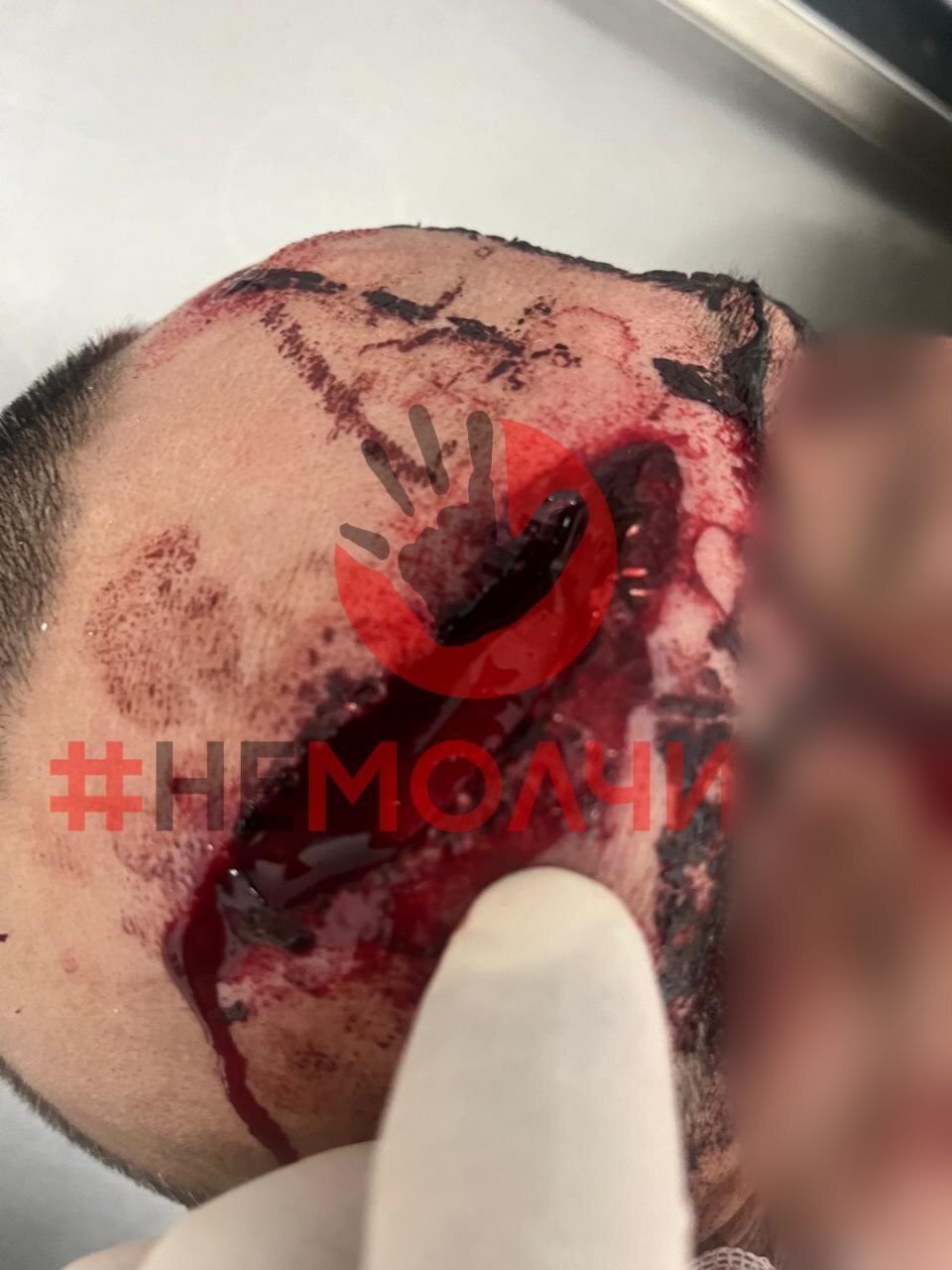 Ex-Husband Attacks Wife And Her Boyfriend With Bat In Kazakhstan