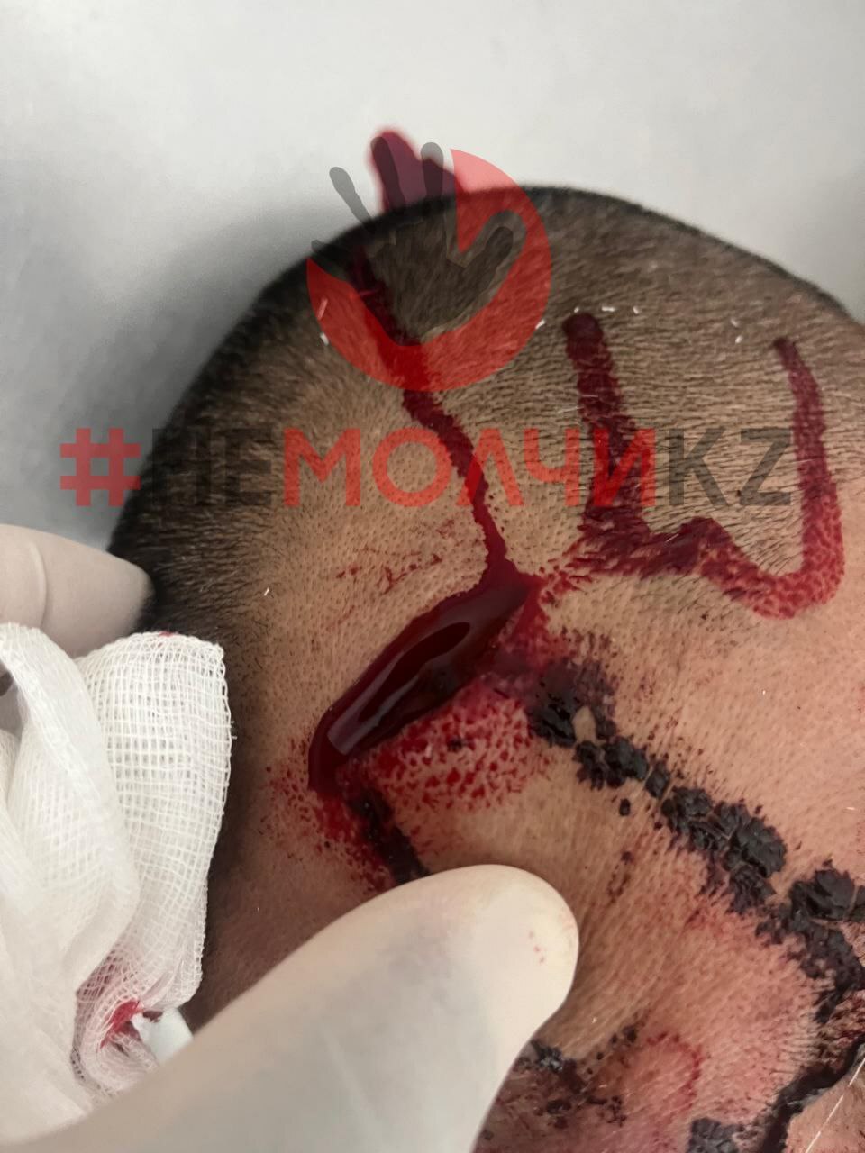 Ex-Husband Attacks Wife And Her Boyfriend With Bat In Kazakhstan