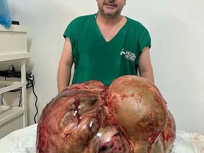 Woman With 45kg Tumor Removed [1-5 images]