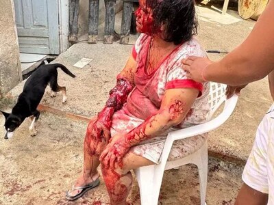 Woman's Scalp Ripped Off By Her Own Pitbull (Photos)