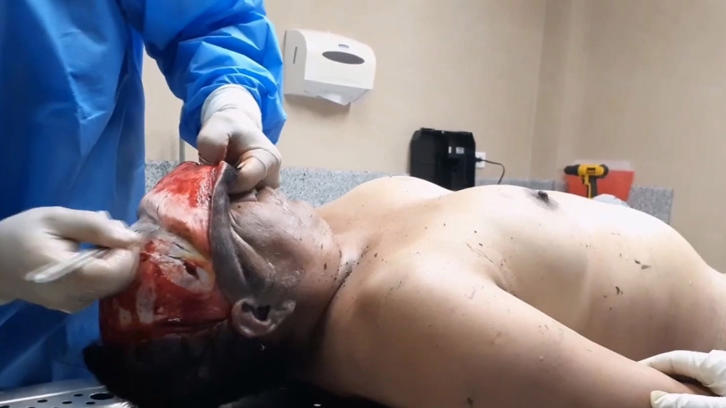 Autopsy of drowned woman