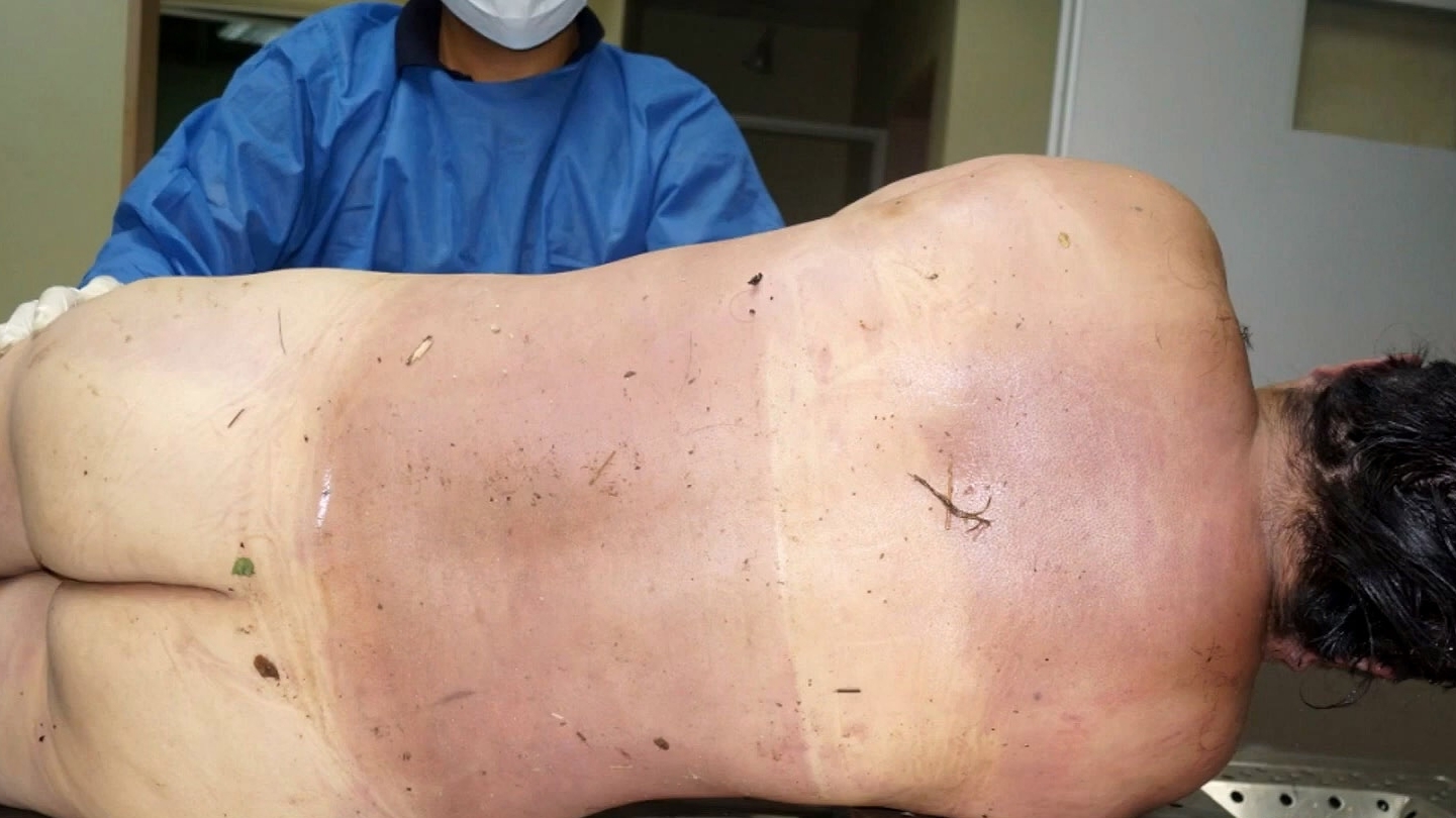 Autopsy of drowned woman