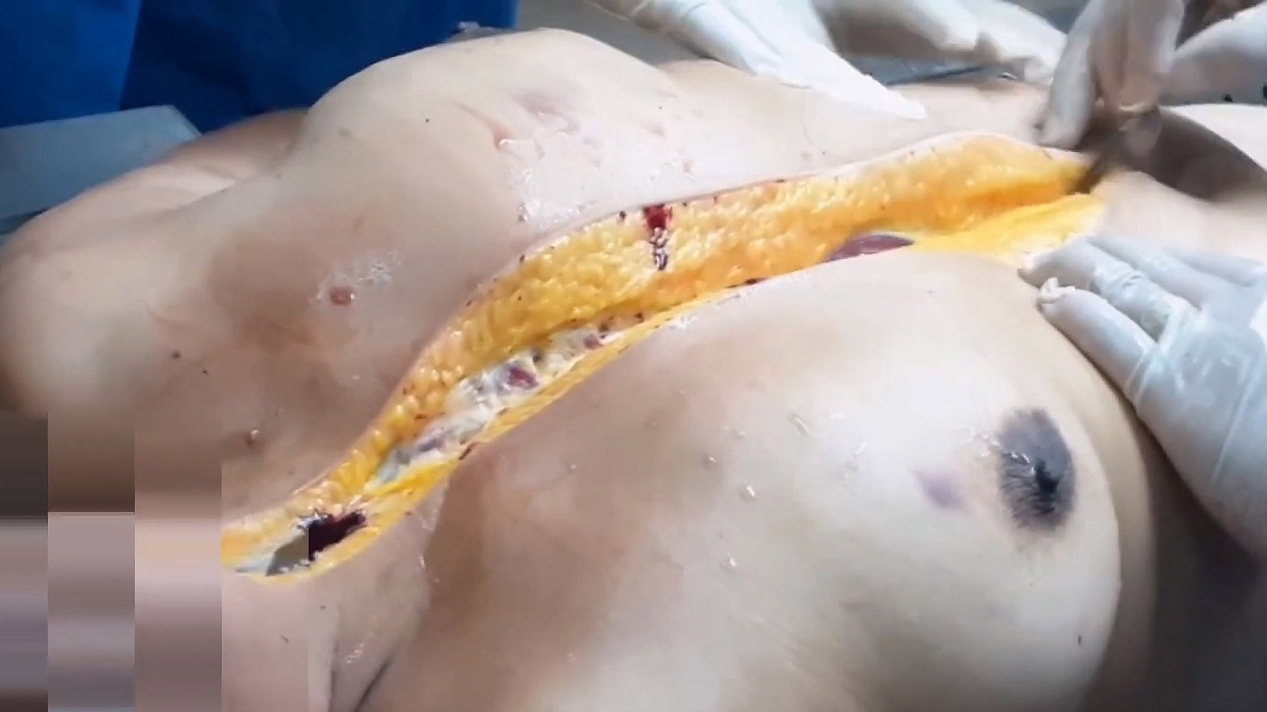 Autopsy of drowned woman