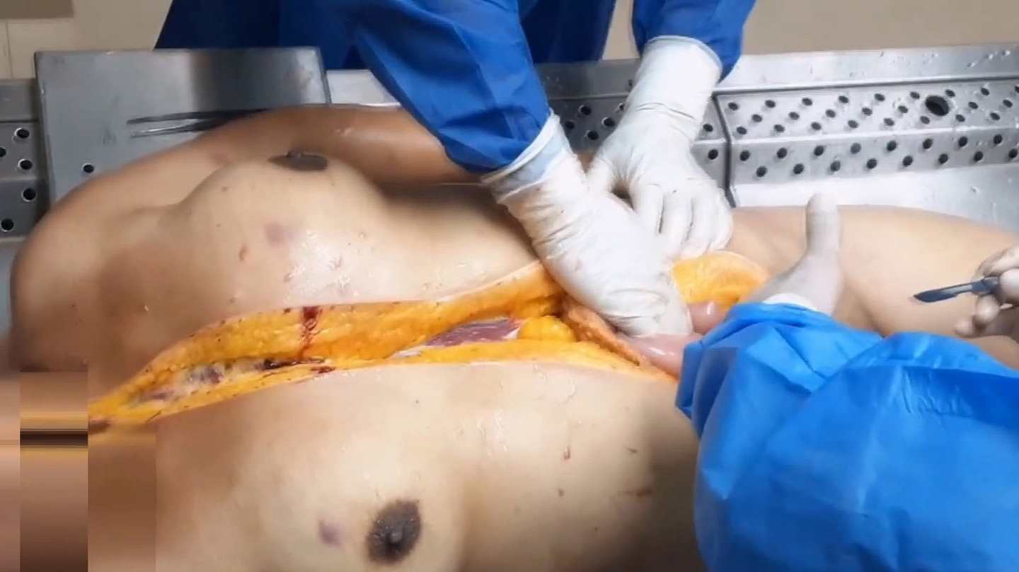 Autopsy of drowned woman